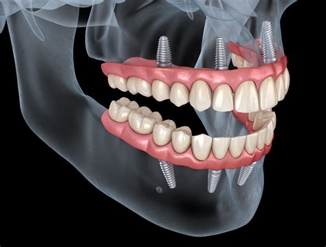 implante dentário protocolo.